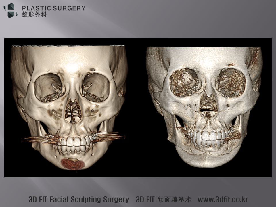 환자의 정면 수술 전후 3D CT 모습입니다. 수술 후 3D Fit PMMA 보형물이 삽입된 모습이 의도적으로 오른쪽으로 삽입 되었습니다. 이에 대한 자세한 설명은 동영상 참고 하시기 바랍니다.