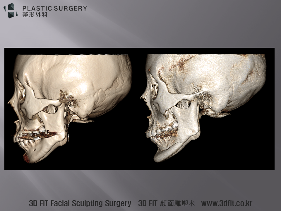 3D CT 측면 모습입니다. 하악왜소증 안면비대칭 이중턱 이 모든 것이 동반된 환자에서 턱끝보형물 은 측면에서 약간의 개선이 있을뿐 턱선이나 옆턱의 함몰을 해결해 주지 못하는 한계가 있다고 생각됩니다. 또한, 단순한 보형물은 안면 비대칭이 심한 환자에서 오히려 비대칭을