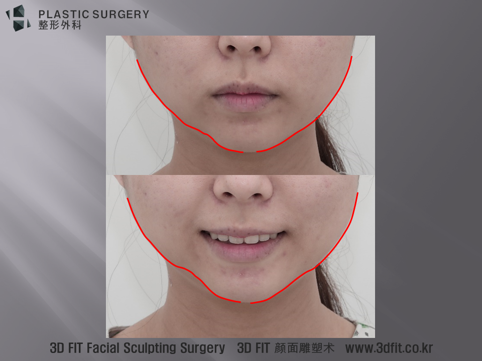 보조선을 통해서 보면 좌우 비대칭과 함몰 부위가 보다 명확히 관찰 됩니다.