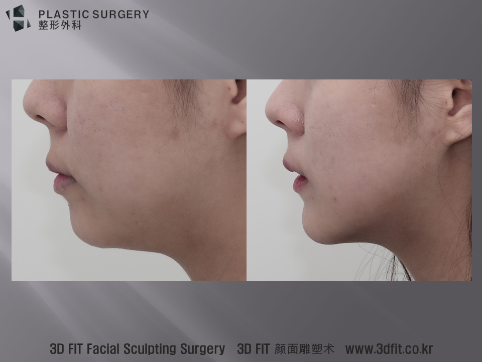 수술 전후 측면 모습입니다. 수술 후 모습에서 턱선이 또렷해지고, 턱-목 각도 (Cervico Mental Angle)가 날렵해진 모습을 볼 수 있습니다.