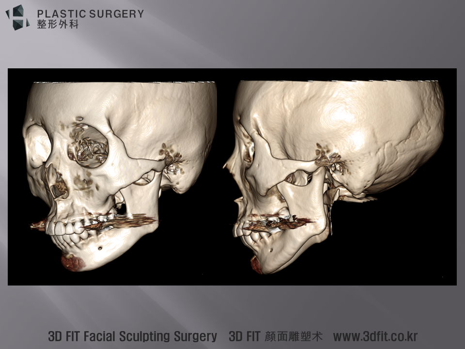 3D CT 측면 사면 모습입니다. 비대칭과 보형물의 모습을 확인 할 수 있습니다. . 안면비대칭, 무턱 (하악왜소증) 환자에서 턱끝보형물(무턱보형물) 수술은 위에서 설명 드린 내용처럼 한계점이 존재 합니다. . 이러한 환자에서 시행된 3D Fit PMMA 보형물 을 활