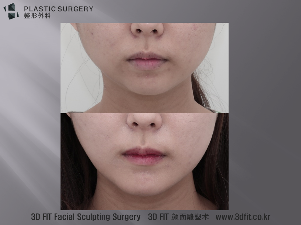 환자의 수술 전후 모습입니다. 자세한 내용은 동영상 참고 하시기 바랍니다.
