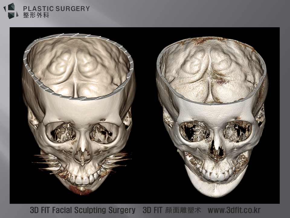 고개를 숙인 모습에서 의도적으로 틀어지게 만들어진 3D Fit PMMA 보형물을 확인하실수 있습니다. 이렇게 만든 이유에 대해서는 동영상 참고 해 주시기 바랍니다.