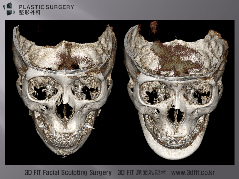 실제 3D CT에서는 비교적 대칭적으로 보형물이 삽입되었지만, 얼굴 전체에 걸쳐서 있는 안면비대칭의 영향은 완전히 극복이 힘들다 판단 됩니다.
