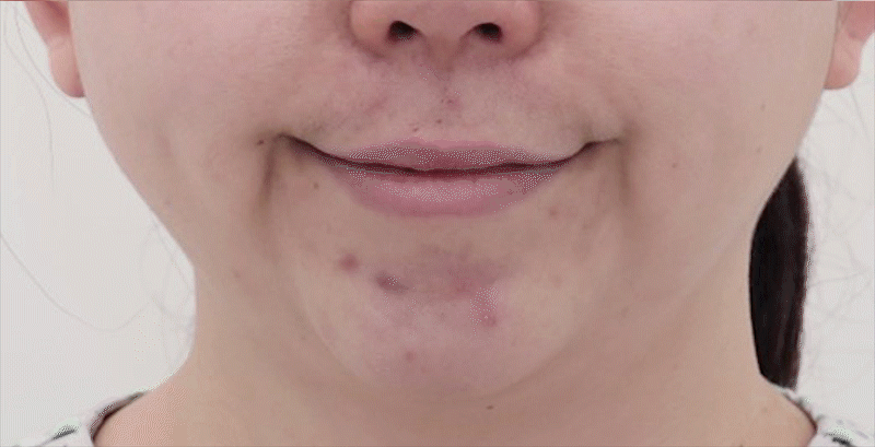 짤막한 움짤 만들어 보았습니다. 사진 촬영 각도가 조금씩 차이가 나지만, 참고하시기에는 도움이 되리라 생각됩니다. 잊지 마셔야 할 부분은 최종 결과는 최소 6개월이 경과해야 정확히 판단할 수 있다는점 환자마다 부기와 회복속도는 굉장히 차이가 많다는점 (위 환자분은 많이