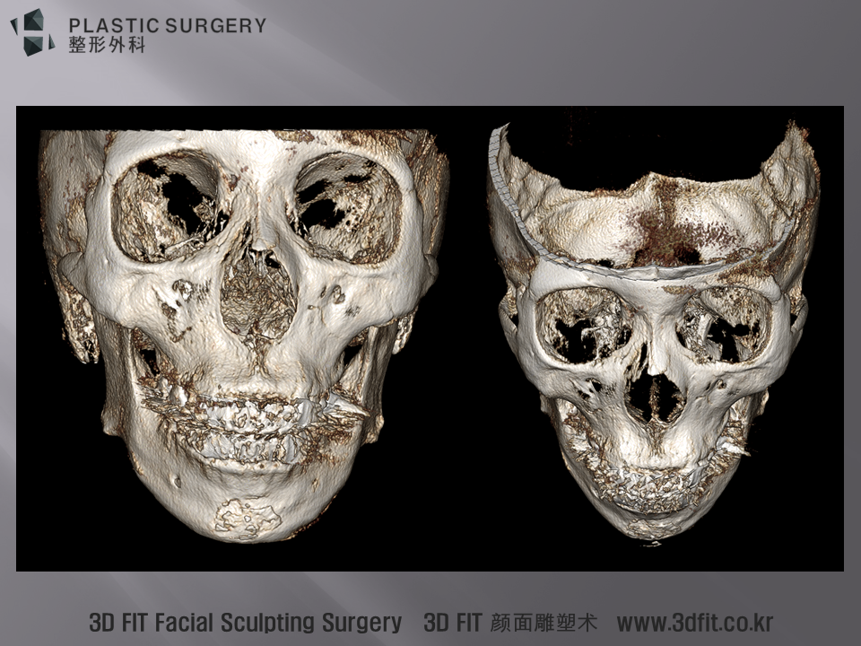 3D CT 에서는 고어텍스 무턱보형물 주변으로 가골이 만들어져 울퉁불퉁한 뼈의 흔적이 관찰됩니다. 가골에 대한 내용은 아래 링크글 참고 하시기 바랍니다. http://blog.naver.com/ys100ps/220321946579