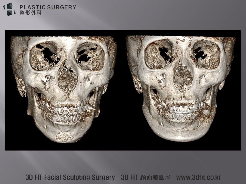 위 환자의 수술 전후 3D CT의 모습입니다. 안면비대칭이 관찰되는 수술 전 모습과 3D Fit PMMA 보형물이 삽입된 수술 후의 모습입니다.