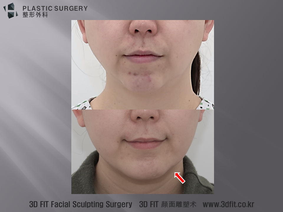 수술 전 수술 후 100일의 정면 모습입니다. 전반적으로는 많은 호전이 이뤄졌지만, 빨간 화살표 부위의 함몰은 아직 남아 있는 모습입니다. 이러한 부분은 이전에 삽입된 고어텍스 보형물 주변의 흉살과 연부조직 변화로 인해 구축이 남아 있는 모습이라 판단 됩니다. 완전한 