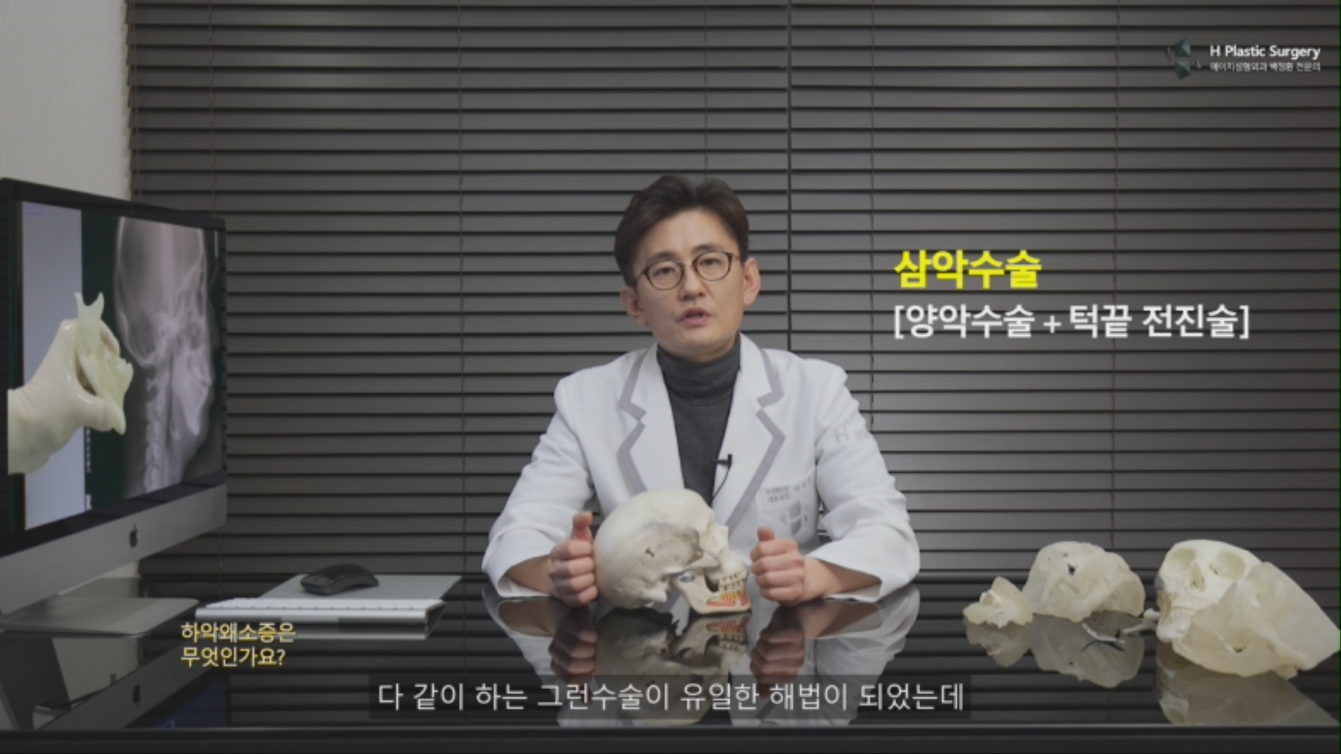 이러한 하악왜소증 환자에서는 삼악 수술이라 해서 양악 수술과 턱끝 전진술을 통해 하악의 전진량을 보완하는 방법이 유일한 대안이었습니다.