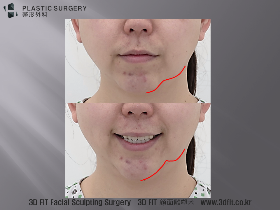정면에서 보면 무표정일때 턱끝의 삽입된 무턱수술 의 무턱보형물의 경계가 명확히 드러나는 모습이 보입니다. 미소짓는 표정에서는 이러한 부분이 더욱 과장되어 보이는 모습 또한 관찰 됩니다.