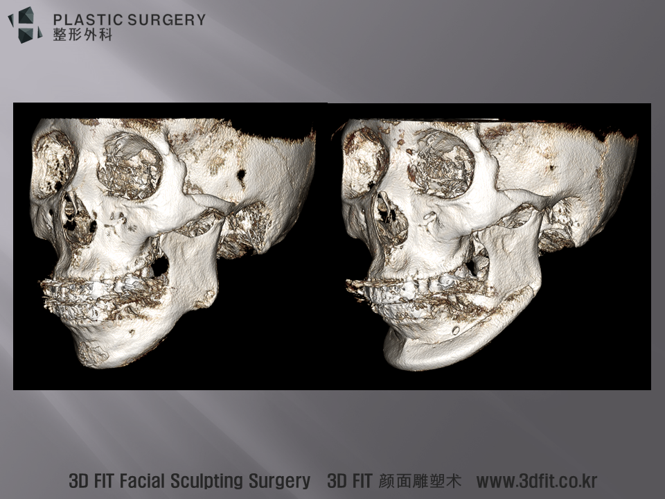 사면 3D CT 모습처럼 3D Fit PMMA 보형물은 측면 부위까지 넓게 환자의 뼈모양에 맞게 제작 할 수 있는 장점이 있습니다.