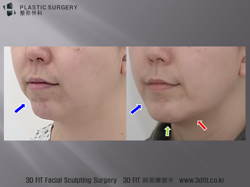 제가 일반적인 무턱 수술과 3D Fit PMMA 수술과의 차이를 설명할 때 가장 중요하게 생각하는 부분이 파란색 화살표 부위 입니다.