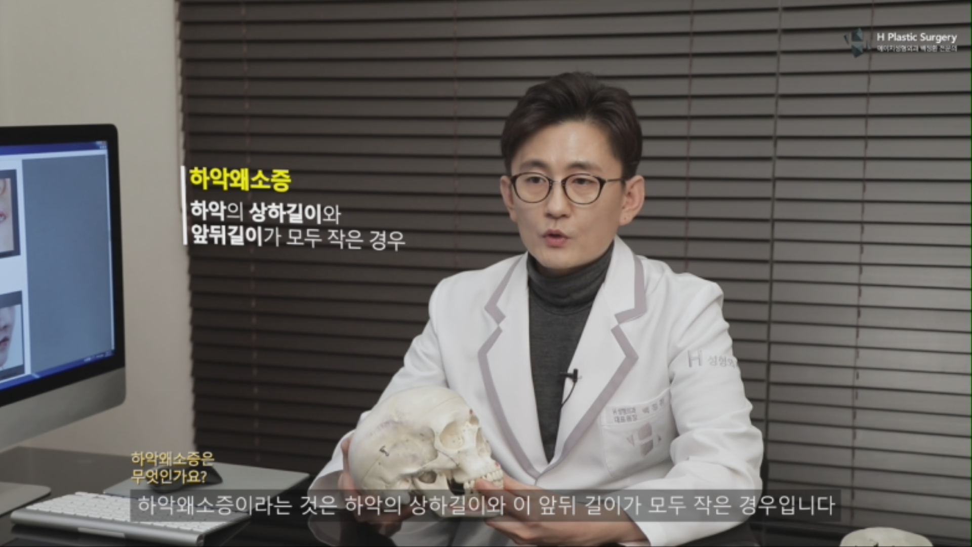 하악왜소증은 하악의 상하 길이와 앞뒤 길이가 모두 작은 경우입니다.