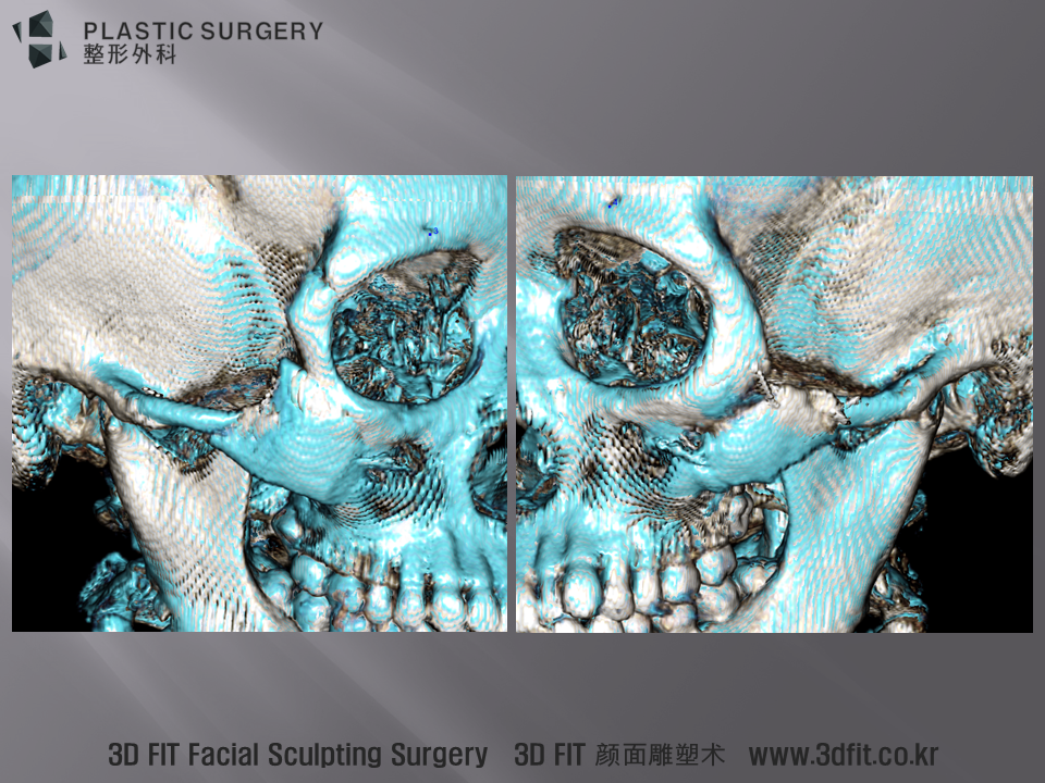 위 사진은 광대재수술 전후의 3D CT를 중첩하여 뼈의 이동이나 볼륨 변화량을 보는 사진 입니다. 수술 전의 파란뼈 와 수술 후의 하얀뼈 의 중첩이미지 입니다.