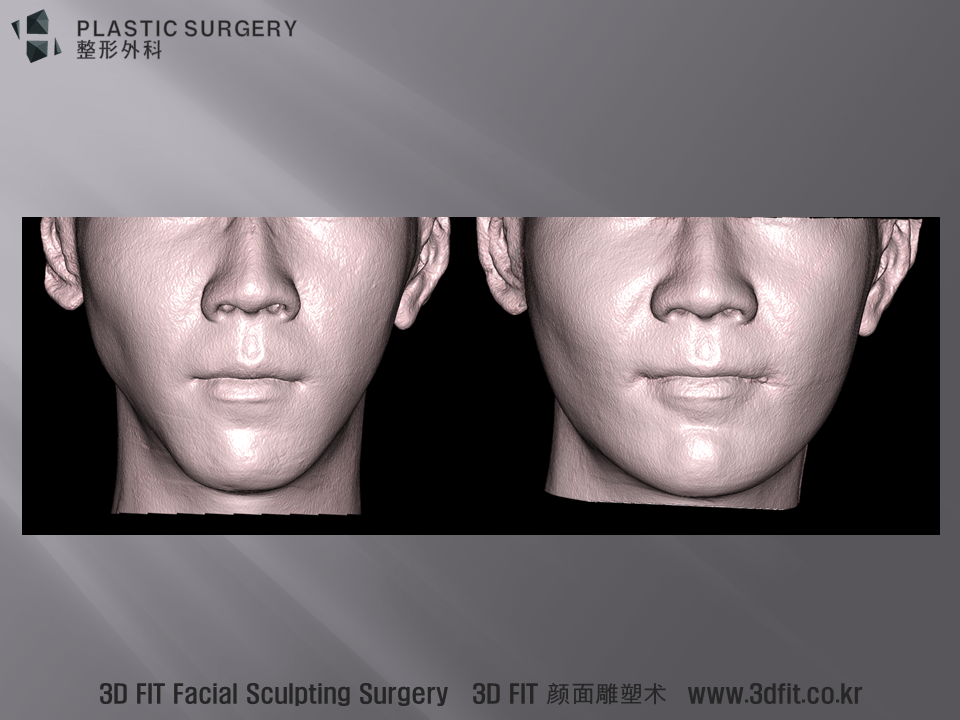 수술 전후를 비교함에 있어 환자의 사진 보다 보다 정확한 음영 정보를 주는 것은 3D CT에서 획득한 피부표면 이미지 입니다. 조명이나, 피부색, 화장에 의한 영향이 없는 아주 객관적이고 정확한 비교 이미지 입니다. 정면 모습에서 수술 전에 관찰되던 하악체부의 함몰과 