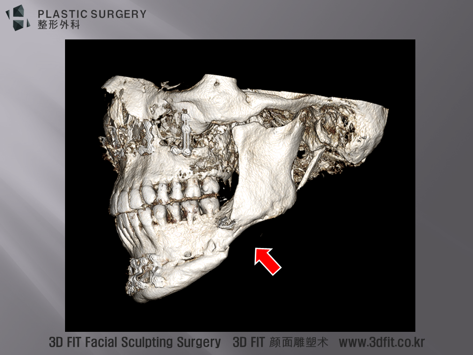 3D CT상의 함몰 부위와 일치하는 것을 확인 할 수 있습니다.