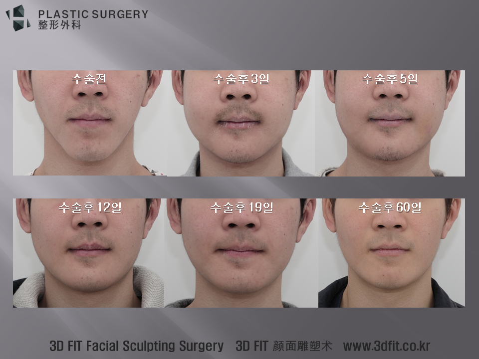 많은 사각턱 재건 또는 하악왜소증 수술을 계획하시는 분들이 제게 묻는 질문입니다. "부기는 심한가요?" "정상생활은 언제쯤 가능하지요?" 이 질문에 명확한 답을 드릴수는 없습니다. 개인차가 심한 부분이기도 하고, 수술 내용에 따라.... 이전에 받은 수술에 따라....