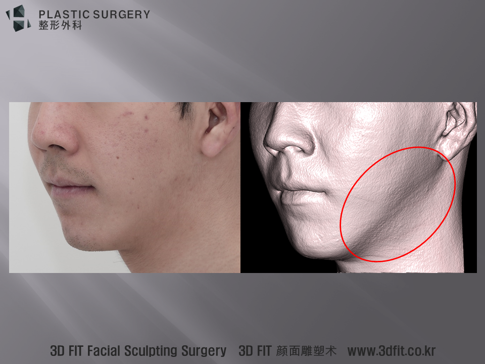 실제 사진 모습과 3DCT surface이미지를 함께 보시면 보다 명확하게 이러한 함몰된 모습이 확인이 되는 것을 알수 있습니다.