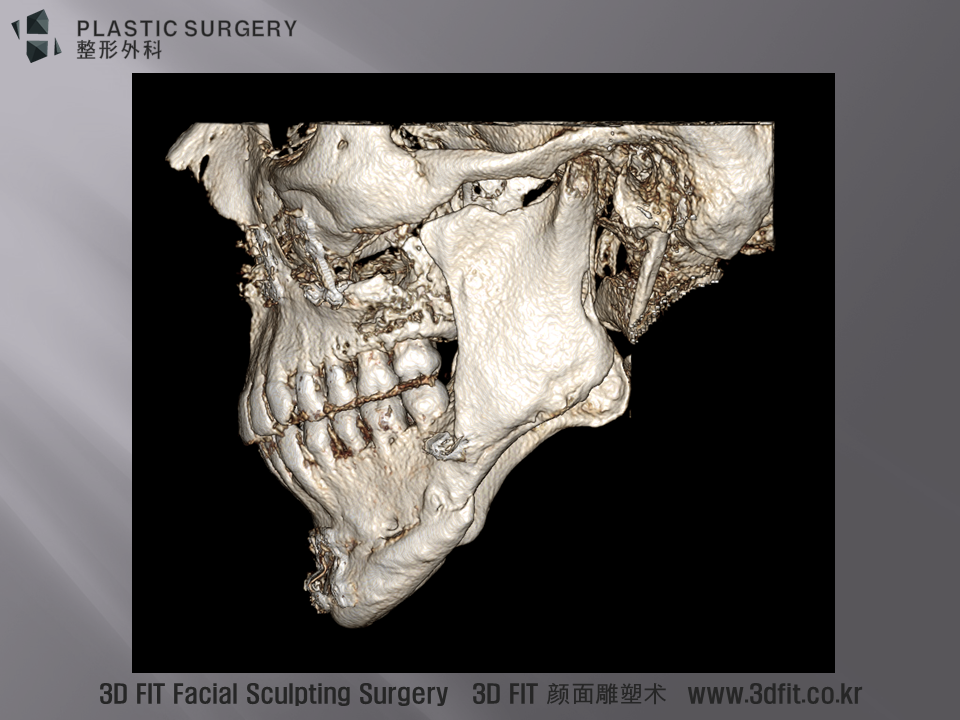3D CT 모습을 보시면, 좌우 비대칭은 양악수술로 교정되지 못했고, 턱끝의 전진을 위한 시상절골한 하악각부위는 뼈의 함몰이 관찰 됩니다. 또한 턱끝전진술이 시행된 턱끝도 3개의 플레이트 와 8개의 스크류 로 고정했음에도 불구하고 전진된 양은 거의 없고, 시계 반대방향