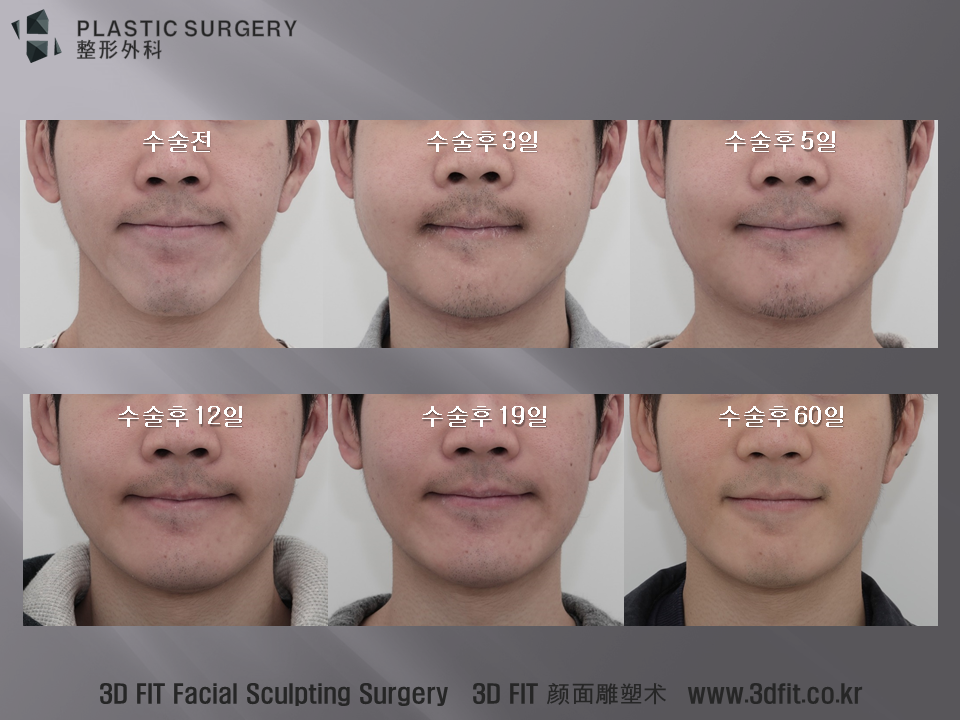수술 전과 수술 후 시간이 흐르면서의 모습에 대한 내용은 동영상에서 자세히 설명 드렸습니다.