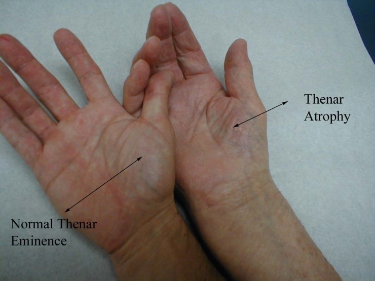 muscles-in-the-hand