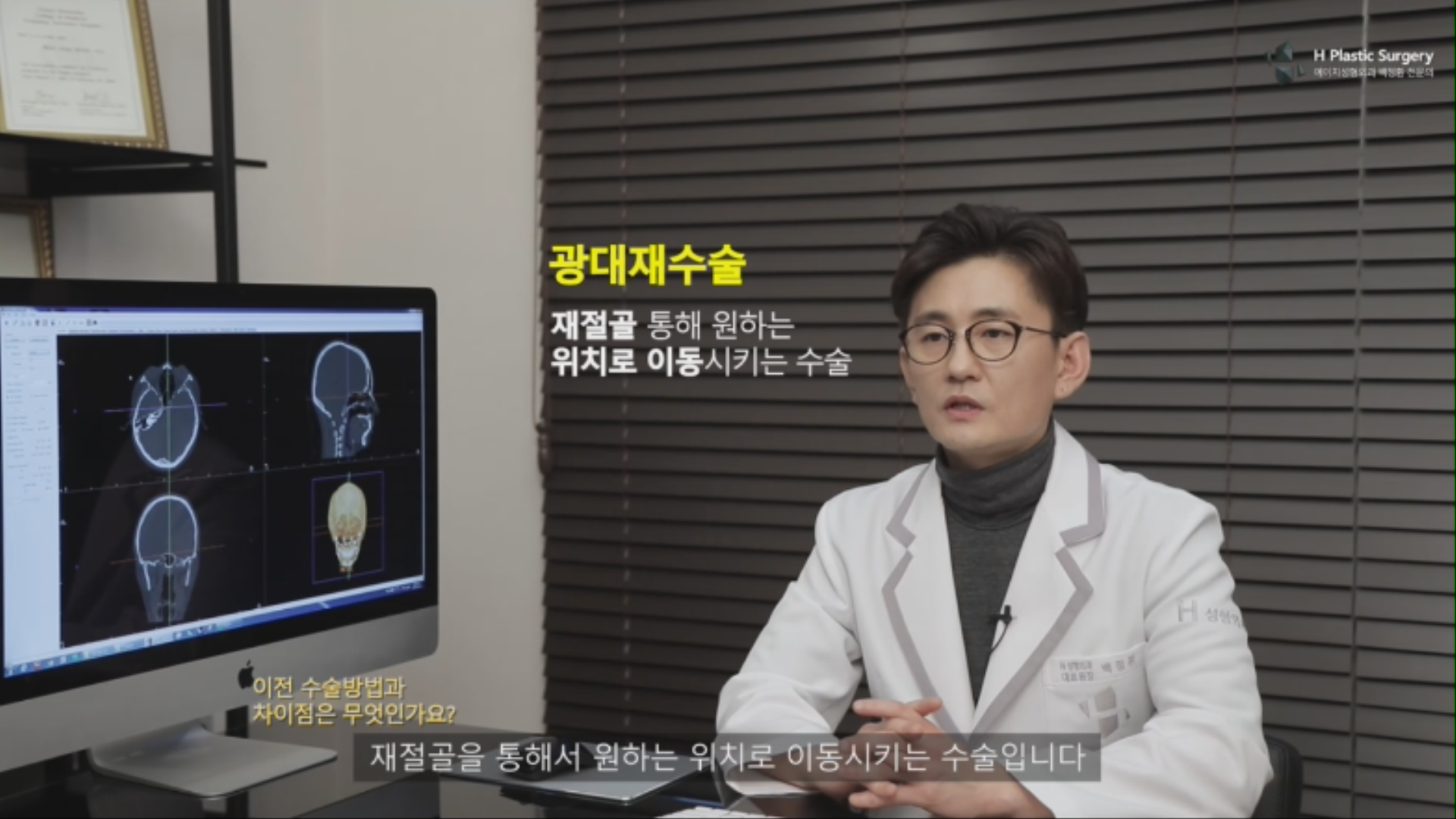 이에 반해 광대재수술은 뼈의 위치이상이 있어, 재절골을 통해 원하는 위치로 뼈를 다시 이동 & 고정하는 방식의 수술입니다. 이때 가장 중요한 전제조건은 뼈의 길이와 양이 재절골 후에도 고정을 할 수 있을만큼 충분 해야 합니다.