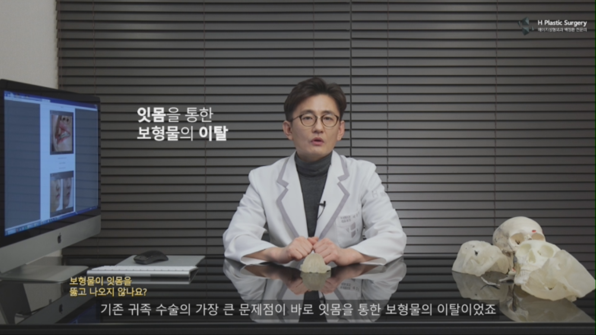 잇몸을 통한 보형물의 이탈이 발생하는 이유는 실제 팔자주름이 생기는 위치가 뼈에서는 잇몸에 너무 가까운 송곳니 뿌리에 위치 하기 때문입니다. 관련 내용은 아래 링크글에서 자세히 설명 드렸습니다. http://blog.naver.com/ys100ps/22042150456