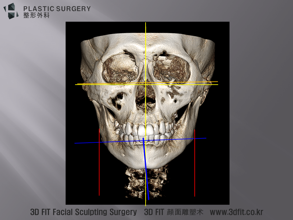 먼저 정면 3D CT에서 보면 노란 수평수직 기준선에 비해 광대 높이는 오렌지 색 선처럼 좌측이 조금 더 높은 상태입니다. 파란선은 하악의 수평 수직선으로 얼굴 전체의 수평수직선인 노란색 선에 비해 우측이 내려오고 좌측이 올라간 상태의 얼굴비대칭이 존재 합니다.