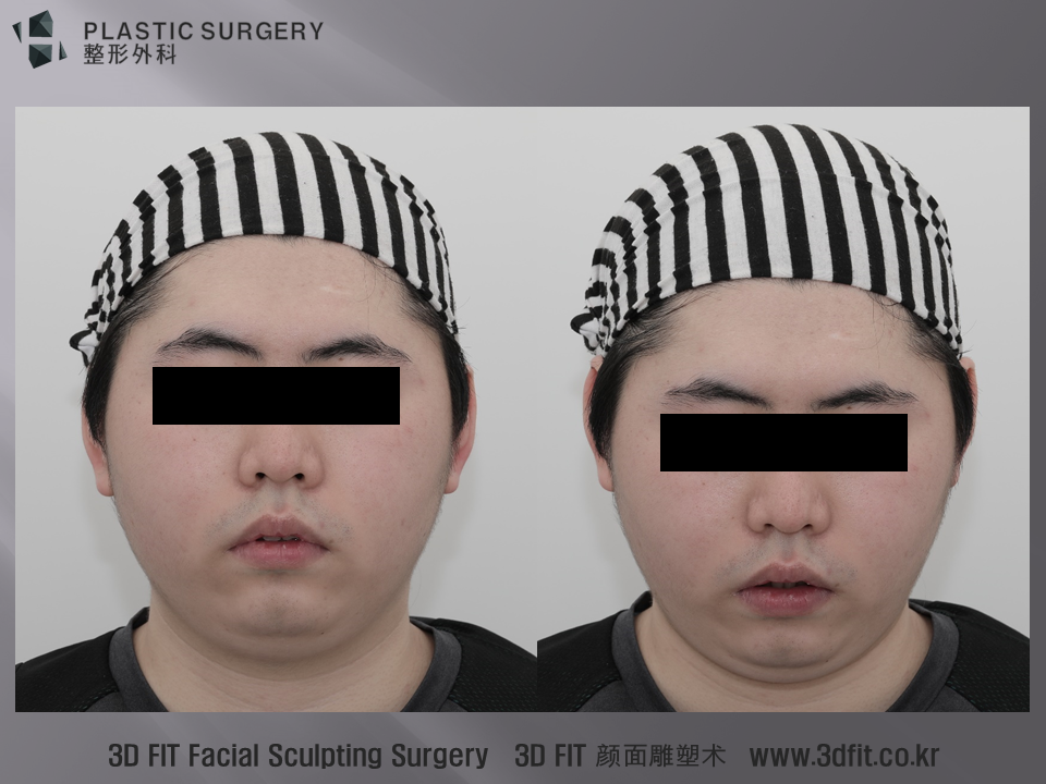 정면 모습에서 옆광대의 돌출과 턱이 왜소한 모습이 확인이 됩니다. 무턱과 이중턱이 같이 관찰됩니다.