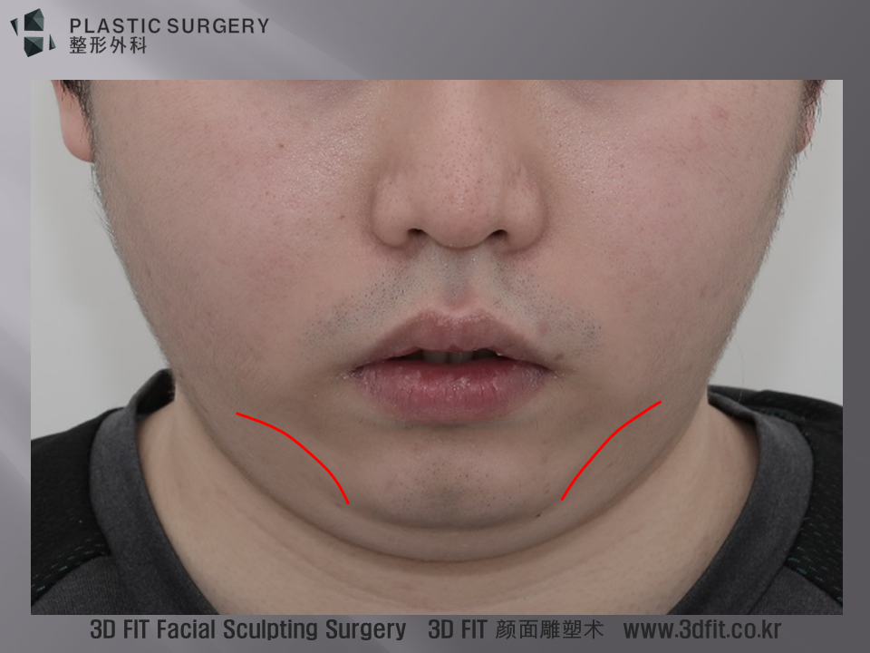 고개를 숙인 모습에서도 특징적인 하악체부의 함몰이 관찰되어 심한 무턱임을 알수 있습니다.