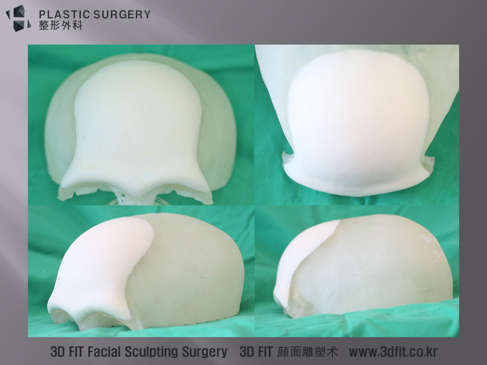 환자의 두개골 CT를 통해 두개골 모형을 3D 프린터를 활용해서 출력하게 됩니다. 이러한 3D 프린팅 모델을 통해서 PMMA 보형물을 제작한 모습입니다.