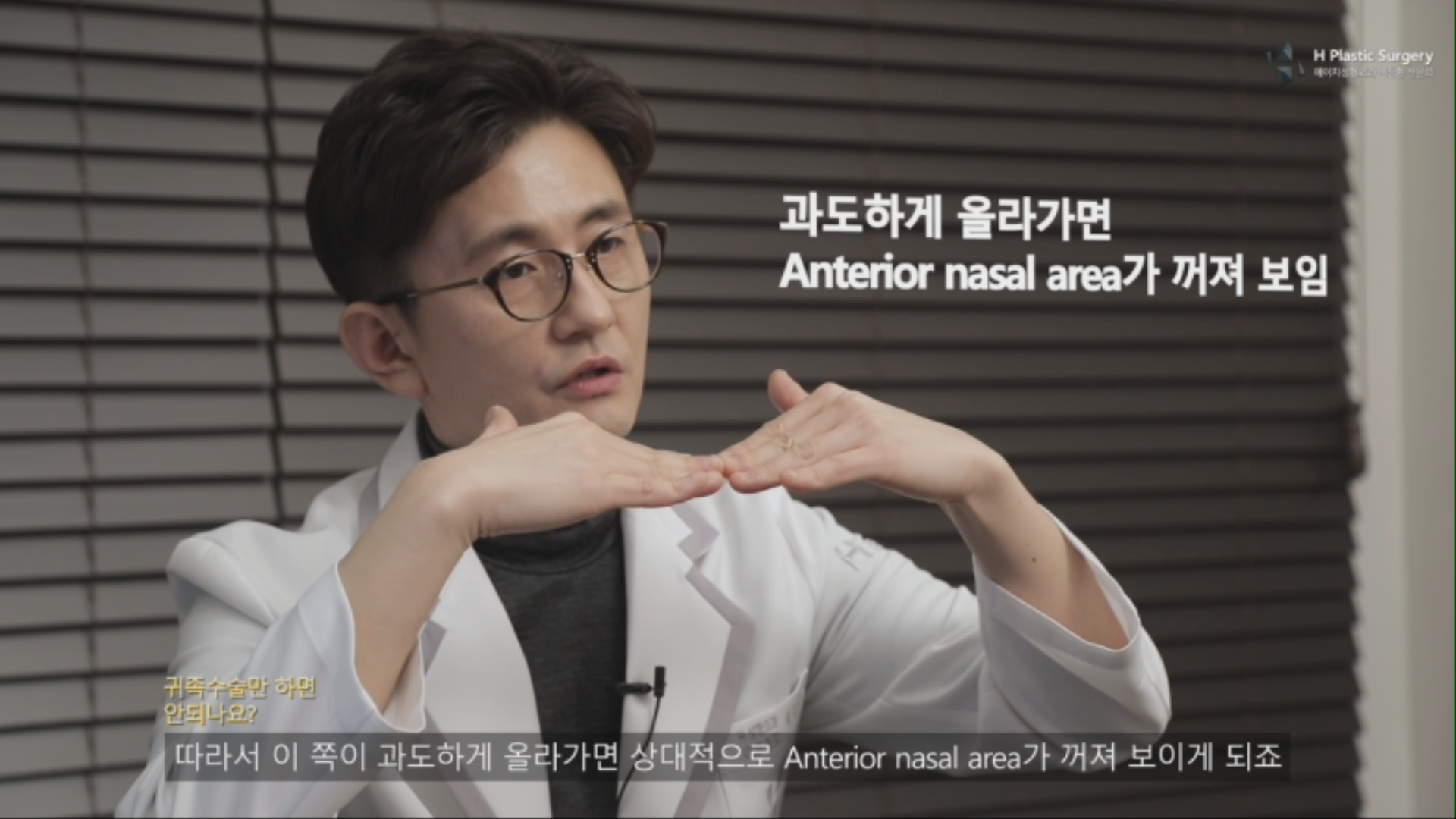 하지만, 귀족부위가 과도하게 올라가면 고양이 부위 (Anterior nasal spine)가 상대적으로 낮아지거나 편평해지는 현상이 생기게 됩니다.