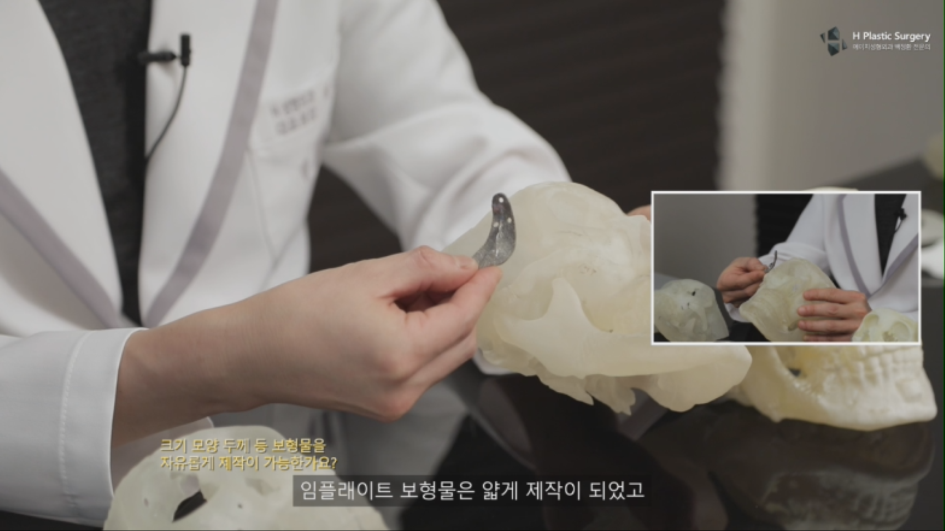 두번째 경우는 광대 갭 (광대체부결손)이 있는 환자에서 디자인된 실제 예 입니다.