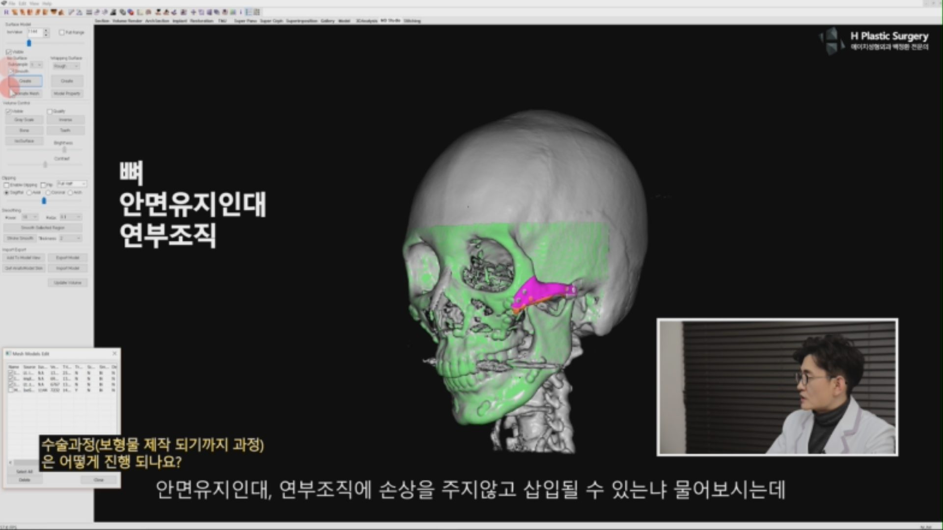 많은 분들이 이렇게 큰 보형물이 주변손상을 주지 않고, 어떻게 삽입과 고정이 가능한지에 대해서 질문주시는듯 합니다. 이 내용에 대해서는 추후 자세히 설명 드리겠습니다.