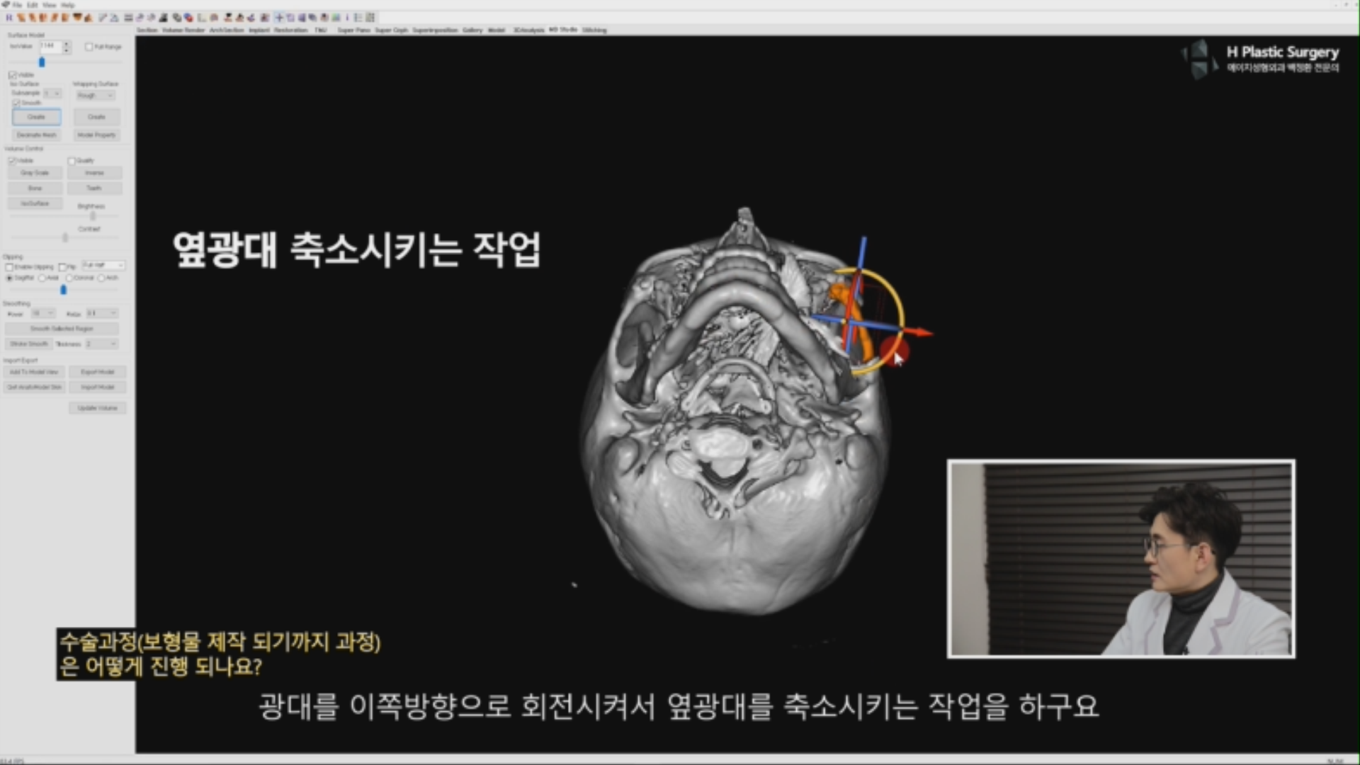 튀어나온 옆광대로 인한 광대비대칭을 해결하기위해 옆광대를 축소시키는 것