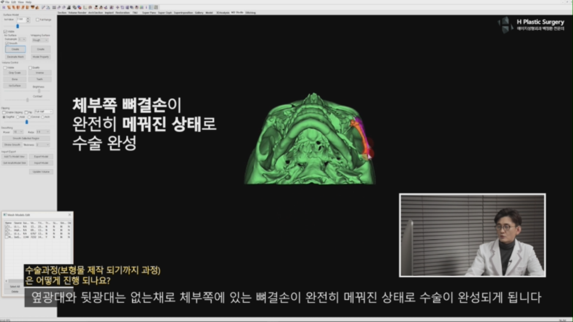 이렇게 디자인된 임플레이트(Implate) 보형물을 활용한다면, 앞서 말씀 드린 옆광대를 축소시키는 것 옆광대를 축소시키는 것 뒷광대를 축소시키는 것 광대비대칭을 해결하기위한 3가지 수술목적을 모두 달성할 수 있는 수술방법이 되리라 생각됩니다. . 수술디자인과 수술방법