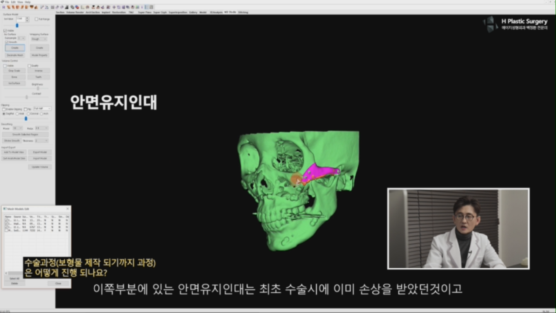 많이 걱정하시는 안면유지인대에 대해서 간단히 설명 드리면, 입안 절개와 구레나룻 절개를 하여 보형물이 삽입될때 손상받는 안면유지인대는 이전 광대수술 시 이미 손상받은 부위 입니다. 재수술을 통해서 안면유지인대가 더 손상받지 않느냐? 는 질문도 많이 주시는듯 합니다. 이