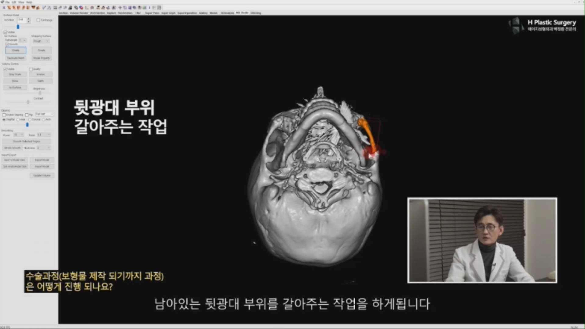 튀어나온 뒷광대로 인한 광대비대칭을 해결하기 위해 뒷광대를 축소시키는 것 이렇게 3가지 수술 목적이 존재합니다. 이러한 목적을 달성하기 위한 컴퓨터 시뮬레이션 수술과정은 동영상을 참고 하시기 바랍니다.