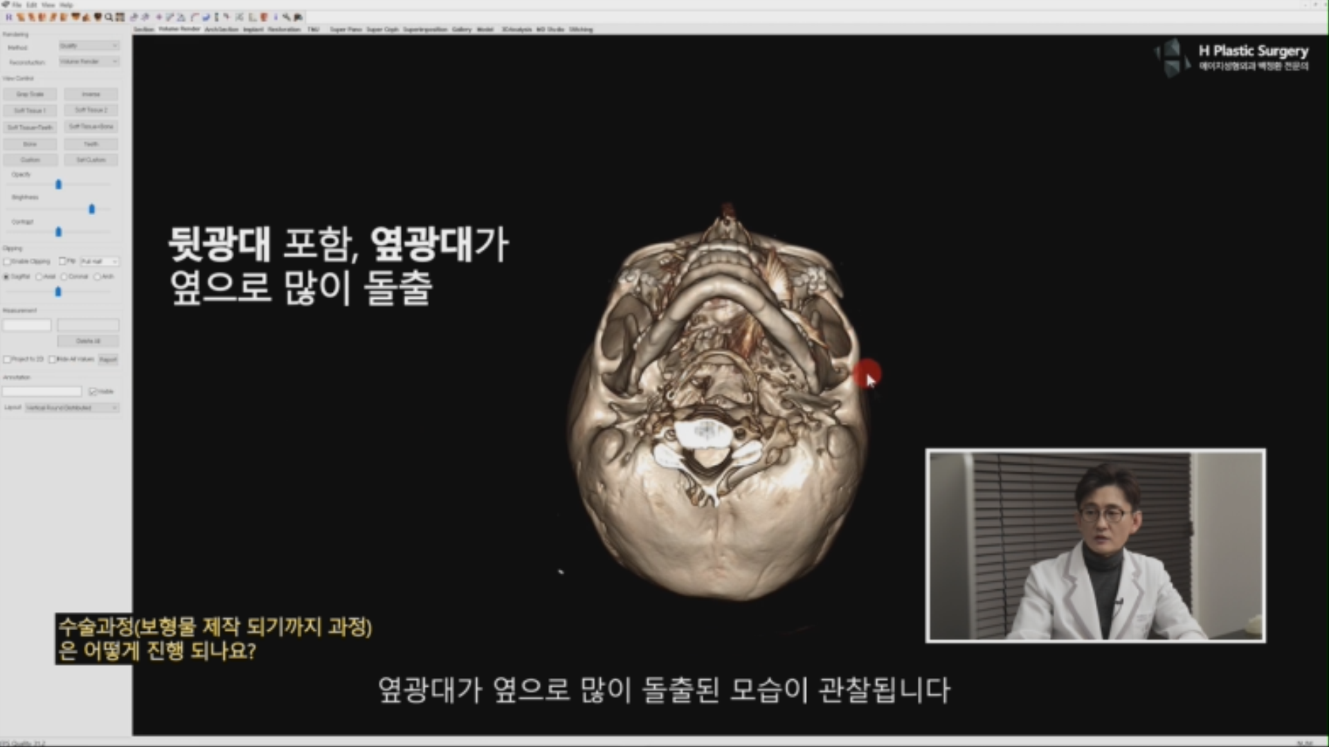 위환자는 체부쪽에는 광대갭이 존재하고, 옆광대와 뒷광대가 튀어나온 광대비대칭 상태의 환자 입니다.