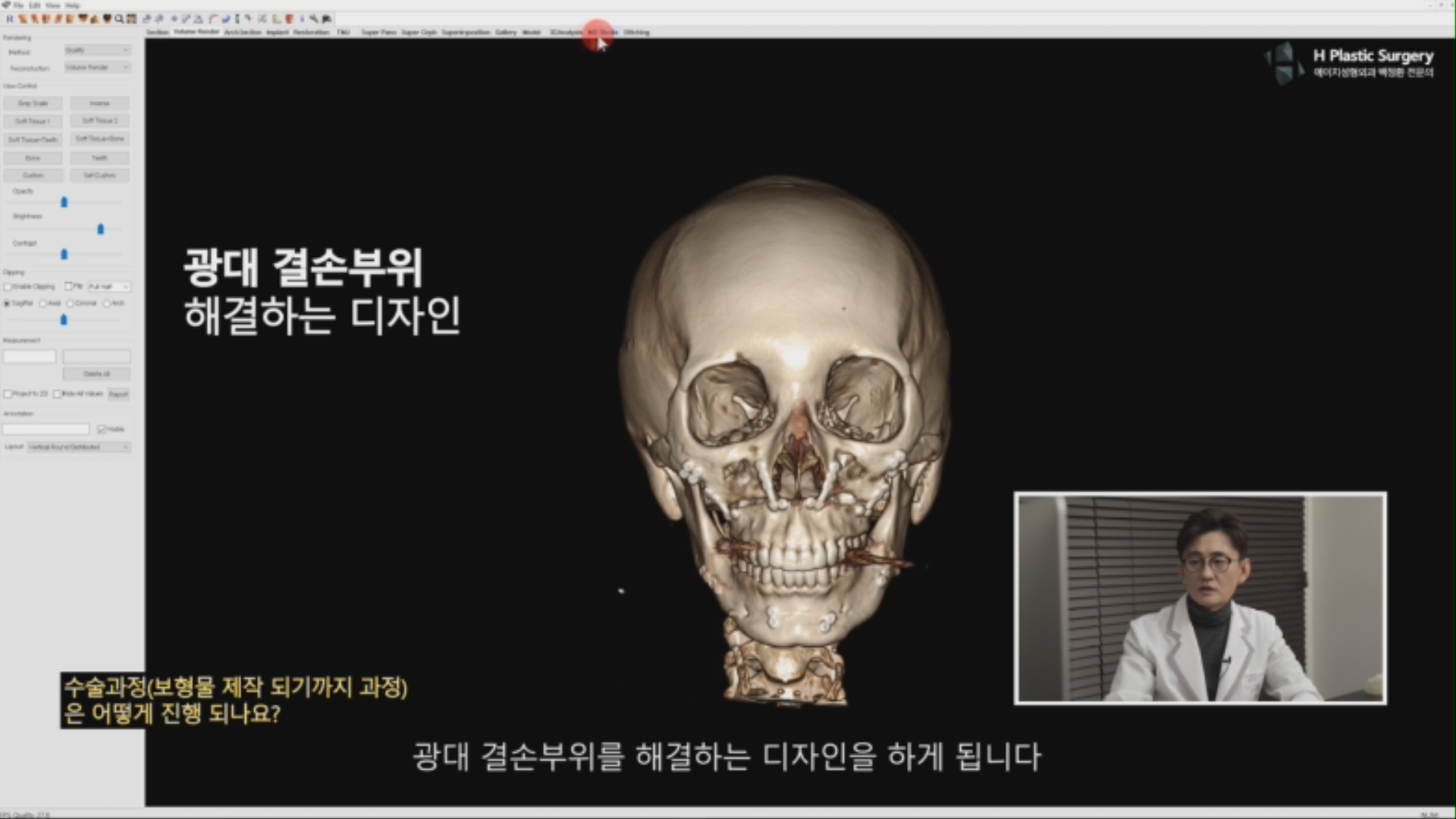 광대비대칭을 해결하기 위해 위 환자에게 필요한 수술적 조작은 광대결손부위를 해결하는 것