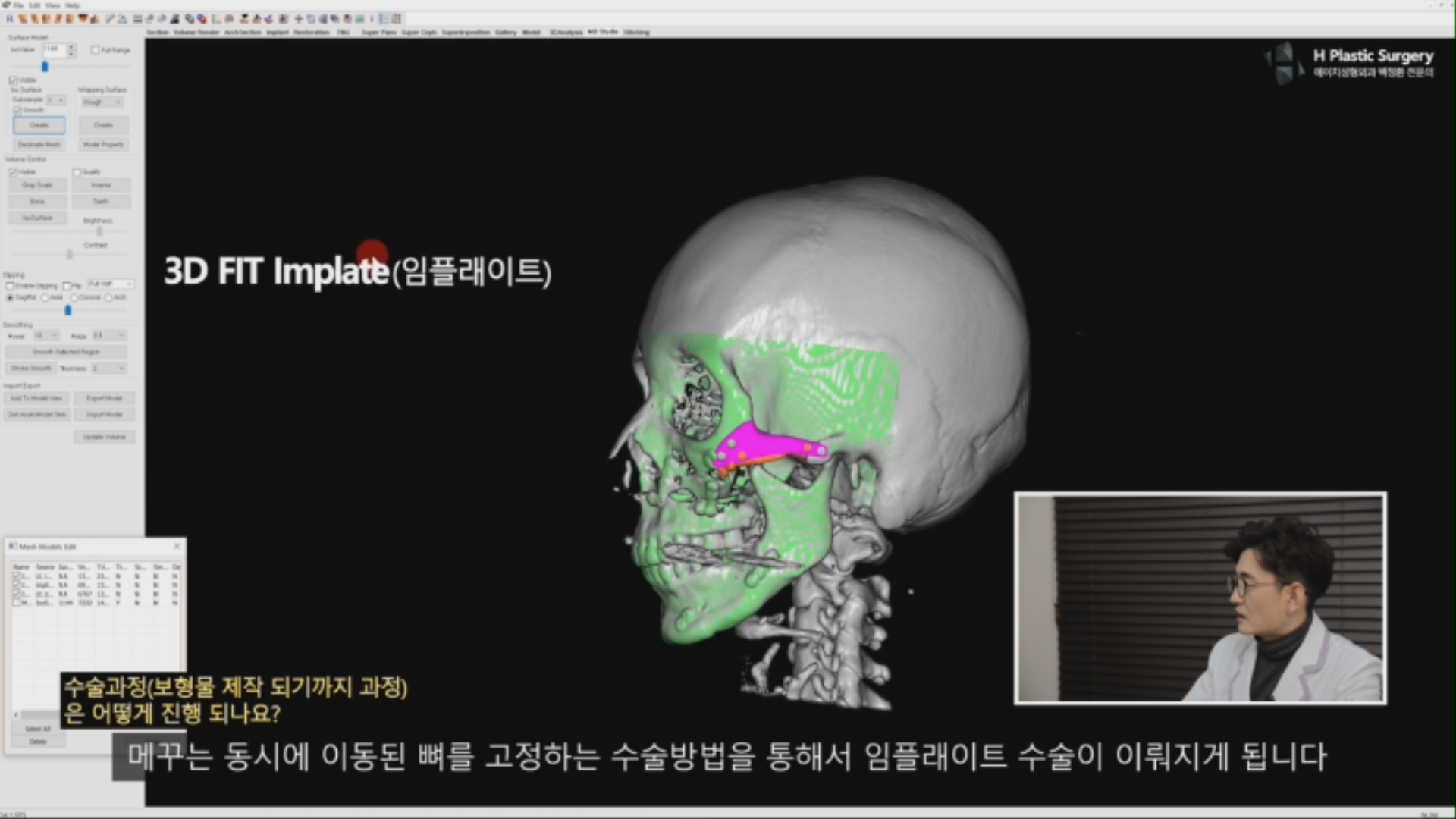 모의수술을 통해서 광대를 절골하고, 이동하고, 삭제한 후에 고정과 결손부위를 메꾸기 위한 임플레이트 (Implate)를 디자인 하게 됩니다.