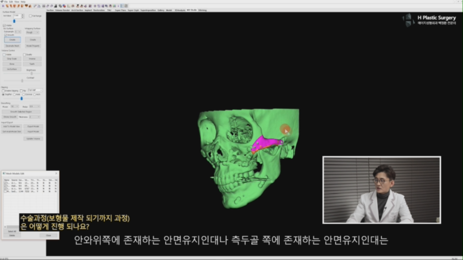 재수술로 인한 안면유지인대 추가손상이 우려된다는 이유로 두피절개를 통해 수술하게 되면, 그나마 손상받지 않았던 측두근 부위와 안와 부위의 안면유지인대마저 손상받게 되는 결과를 초래하기때문에 옳은 선택은 아니라고 판단됩니다.
