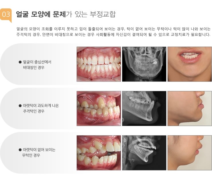 부정교합종류 : 네이버 블로그 부정교합종류 : 네이버 블로그