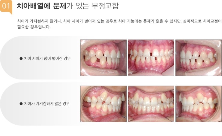 예일바른이치과 : 네이버 블로그 예일바른이치과 : 네이버 블로그