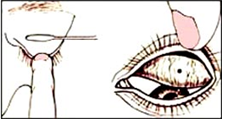 결막 이물 Foreign body in the conjunctiva : 네이버 블로그