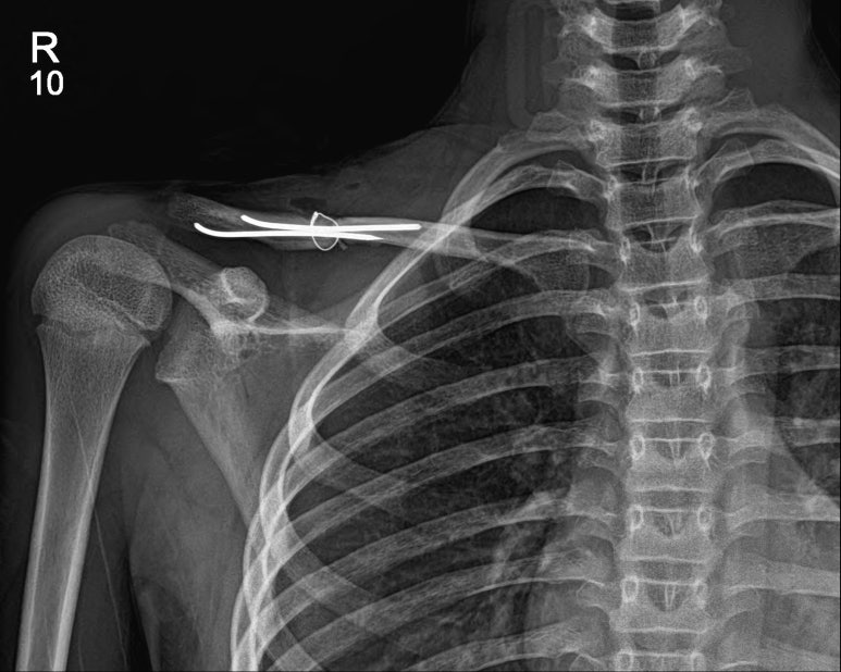 소아의 쇄골 골절에서의 골수강내 핀고정술(intramedullary pin fixation at children`s