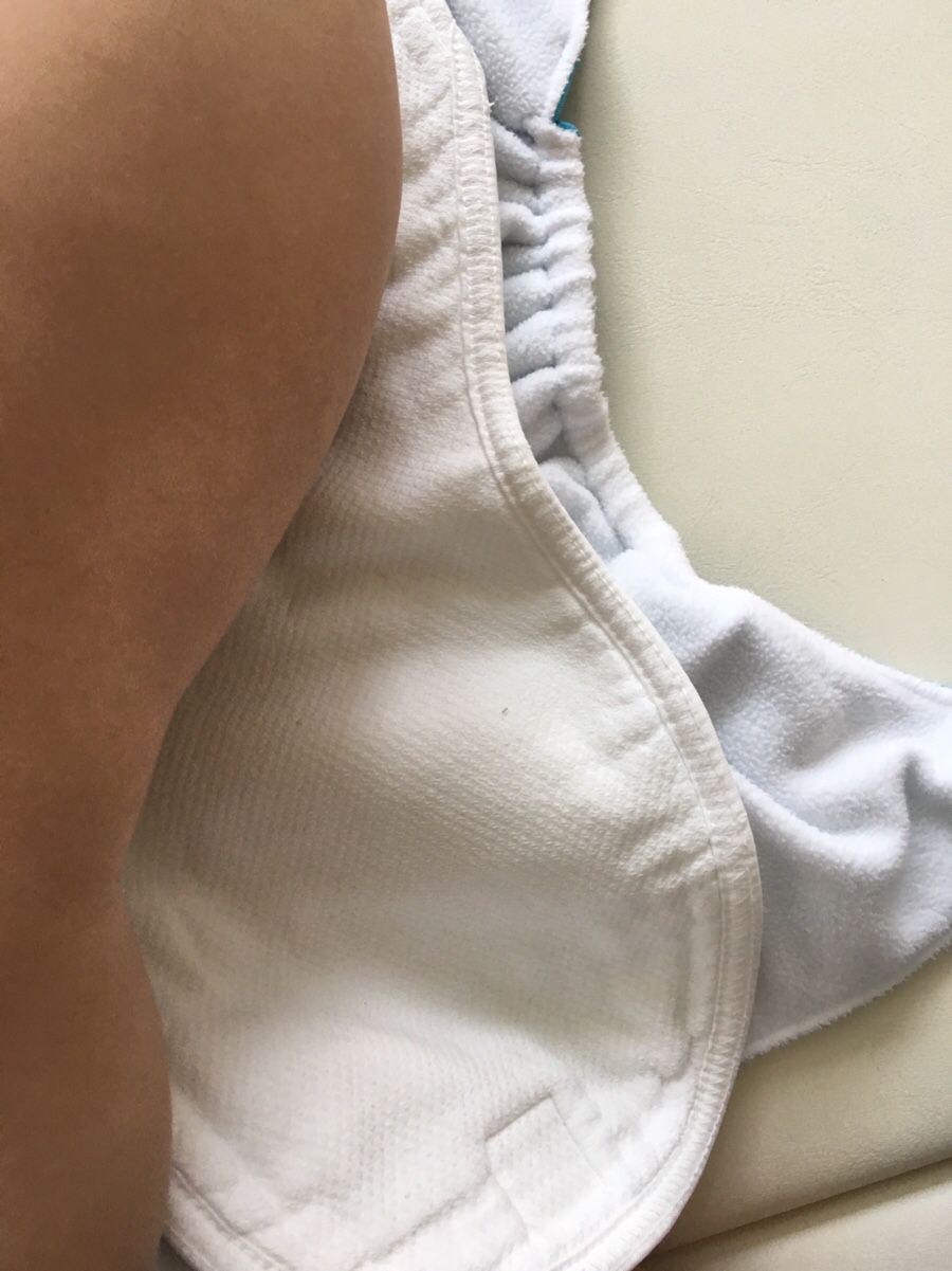 아이 귀두 포피염 아이 고추에서 피가 나왔어요 ㅜㅜ(사진모자이크처리) : 네이버 블로그