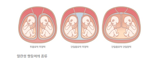 대박, 일란성 쌍둥이 단일융모막이라는 이유로 보험가입 거절이라늬!!! : 네이버 블로그