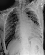 Chest apicography : 네이버 블로그