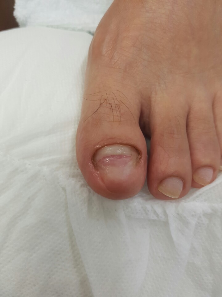레푸스네일 이미지